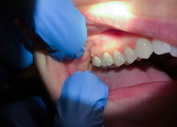 Best Knocked-Out Tooth (Avulsed Tooth) Treatment in Ocean Grove, NJ